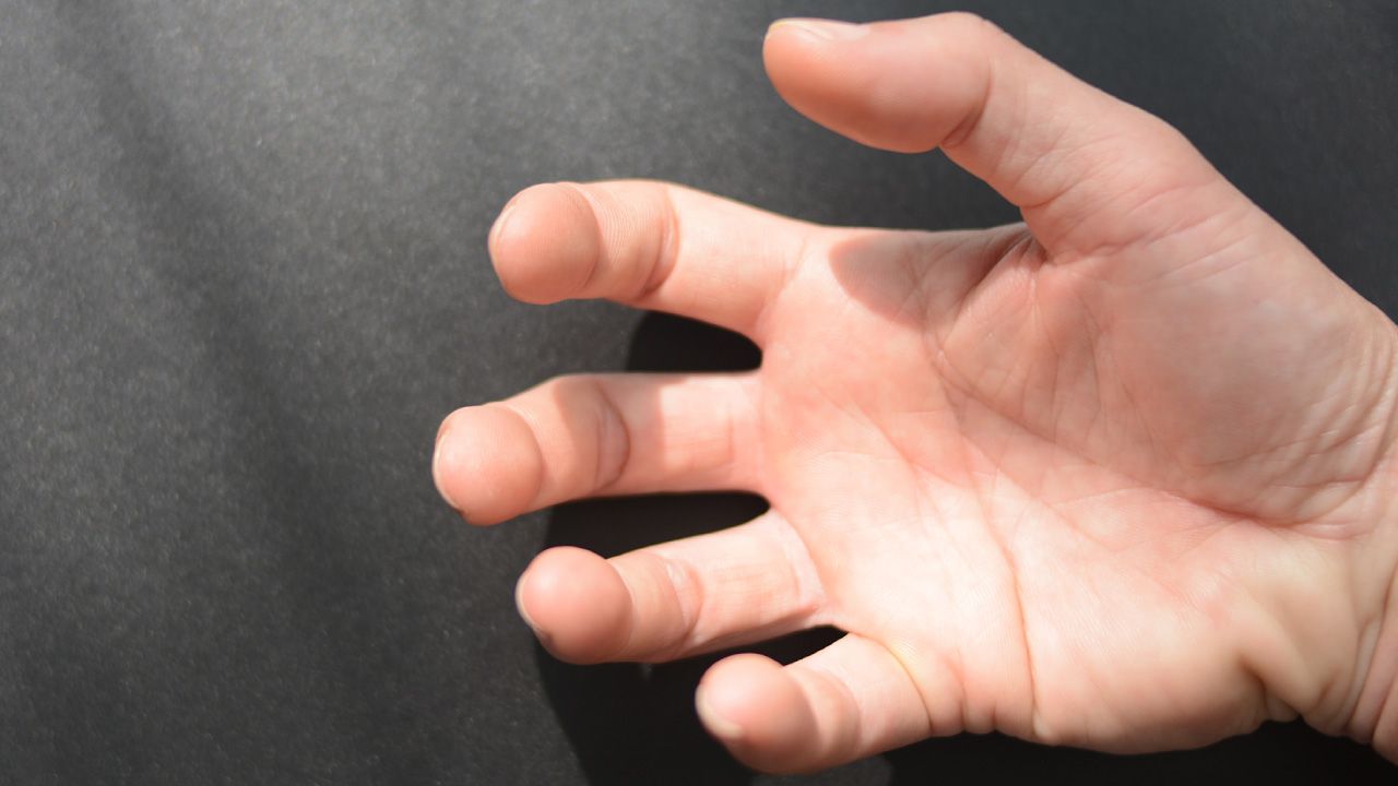 Neuromuscular Disorders