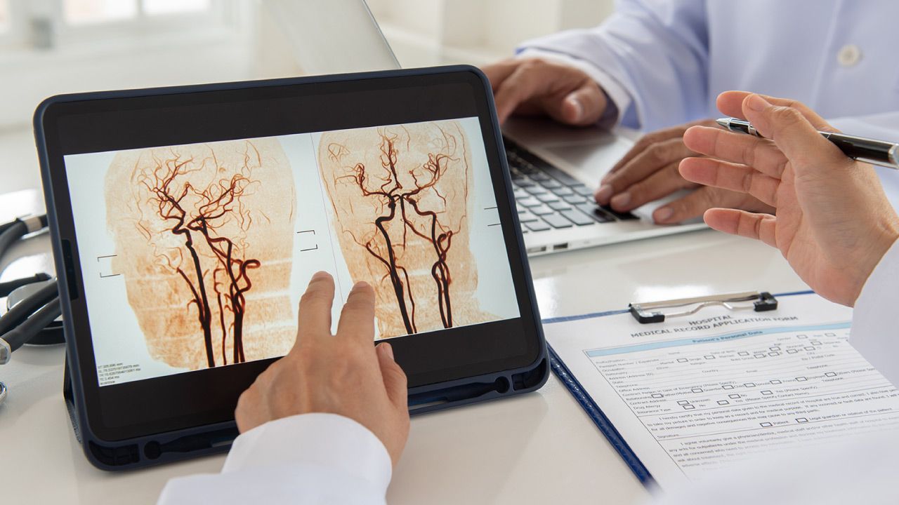 Stroke Management